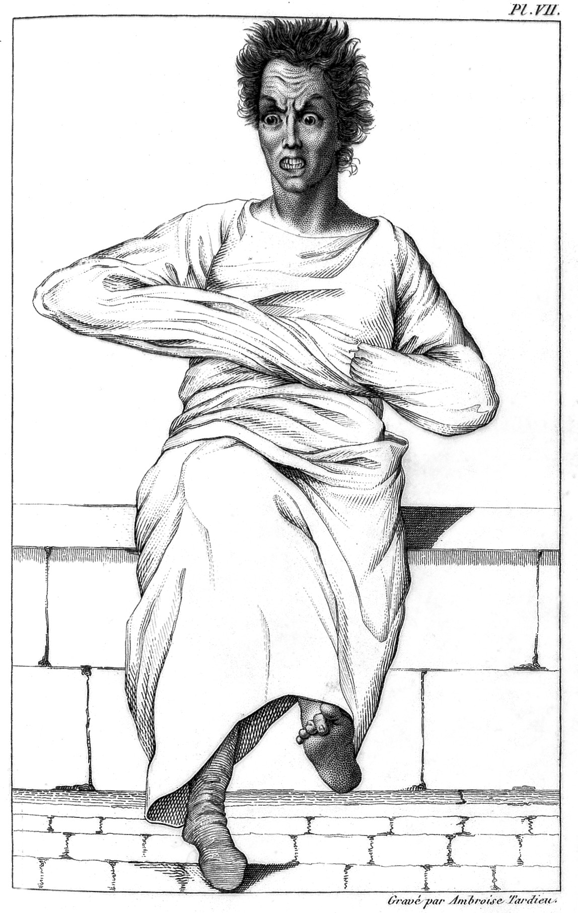 Engraving of a patient restrained in a strait-waistcoat